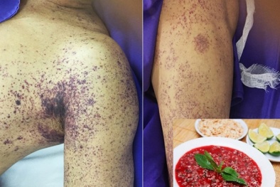 Tử vong sau khi ăn tiết canh nhiễm liên cầu lợn: Cục Y tế dự phòng khuyến cáo gì?
