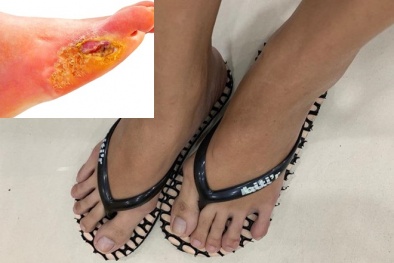 Vì sao người mắc bệnh tiểu đường cần tránh xa dép xỏ ngón 