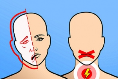 6 dấu hiệu cảnh báo đột qụy đang tới gần cần biết để tránh