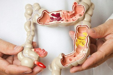 Ung thư đại trực tràng: Những dấu hiệu nguy hiểm nhiều người thường bỏ qua