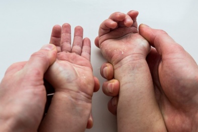 Cảnh báo gia tăng tình trạng sốt phát ban đỏ