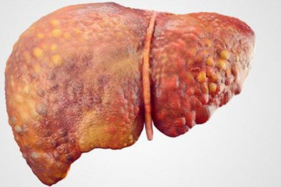 5 thói quen ‘giết chết gan’ nhiều người mắc phải mà không hay