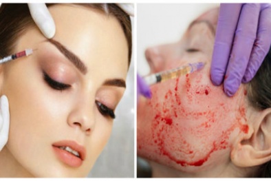 Làm đẹp bằng phương pháp 'ma cà rồng' có thể khiến khách hàng nhiễm HIV
