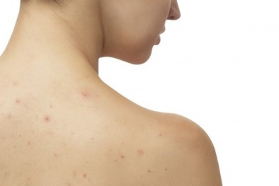 Mẹo trị mụn trứng cá ở lưng đơn giản và hiệu quả nhất