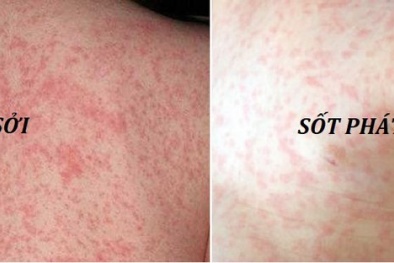 Bệnh sởi trên toàn cầu tăng cao và khuyến cáo phòng tránh cho người dân Việt Nam