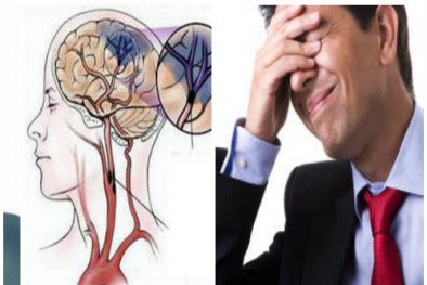 Đột quỵ nhẹ sau cơn thiếu máu não thoáng qua nhiều người mắc, chủ quan có thể tử vong