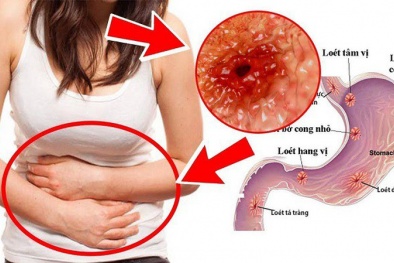 Cô gái 16 tuổi mắc ung thư dạ dày di căn: Những dấu hiệu ban đầu tuyệt đối không được bỏ qua