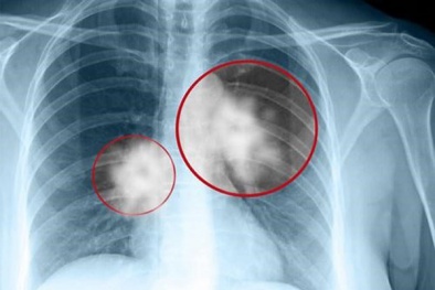 Cô gái trẻ qua đời sau 5 ngày phát hiện ung thư: Những dấu hiệu không thể chủ quan