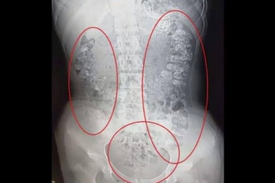 Uống quá nhiều trà sữa, bé gái bị trân châu làm tắc ruột