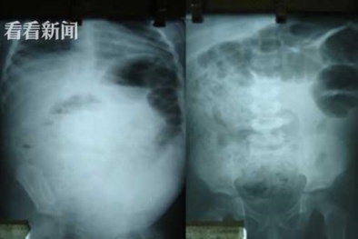 Ổ giun khổng lồ trong bụng bé trai 4 tuổi: Dấu hiệu nhiễm giun thường bị cha mẹ bỏ qua