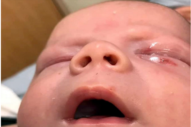 Bé sơ sinh suýt hỏng mắt sau những nụ hôn trong ngày rửa tội