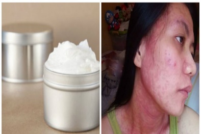 Chất độc thủy ngân có mặt trong nhiều loại kem làm trắng da
