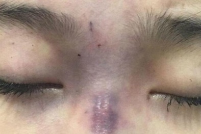 Những biến chứng nguy hiểm vì tiêm filler
