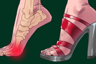Giày cao gót không chỉ hủy hoại đôi chân, còn ảnh hưởng tới nhiều bộ phận khác trên cơ thể