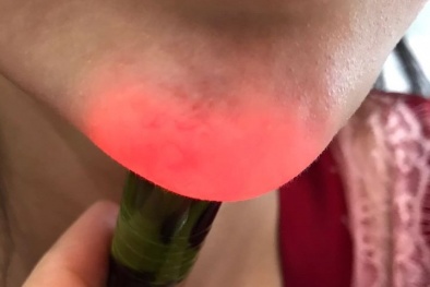 Tiêm filler kém chất lượng: Cảnh báo nguy hiểm từ bác sĩ thẩm mỹ 