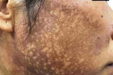 Da mặt chỗ trắng chỗ đen, mạch máu nổi rõ vì bôi kem trộn làm trắng