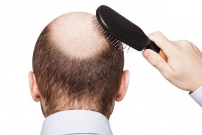 Sử dụng thuốc trị hói đầu có thể làm tăng nguy cơ trầm cảm ở nam giới 