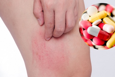 Tác dụng phụ nguy hiểm của thuốc kháng histamin chống dị ứng