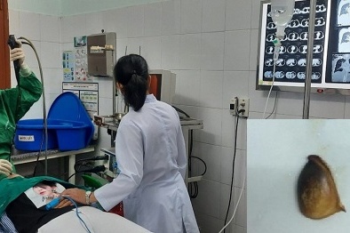 Vô tình nuốt hạt hồng xiêm trong lúc ăn người phụ nữ bị ho ra máu