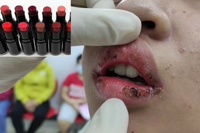 Dùng son môi kém chất lượng và những rủi ro đáng tiếc cho chị em