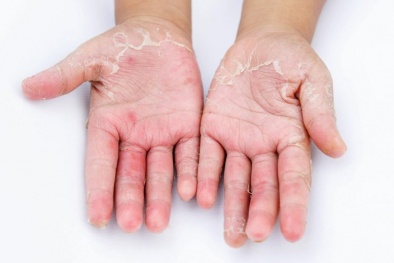 Thường xuyên rửa tay bằng cồn có thể dẫn đến viêm da tay? 