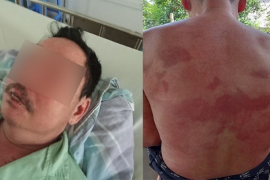 Cảnh báo nguy cơ tử vong do tự ý dùng thuốc kháng sinh, giảm đau chống viêm 