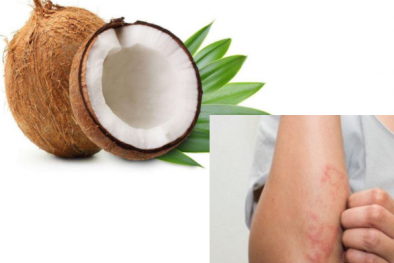 Dừa có thể gây dị ứng, đâu là triệu chứng nhận biết?
