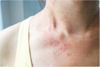 Mề đay hậu Covid-19, chữa thế nào?