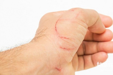 Cảnh báo tình trạng độc tố nhiễm khuẩn uốn ván