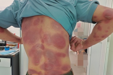 Nhiễm độc toàn thân do tự dùng thuốc điều trị viêm gan B 