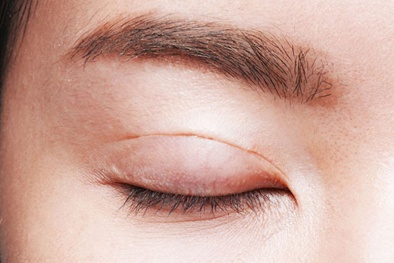 Cắt mí mắt ở cơ sở thẩm mỹ không đảm bảo chất lượng, một phụ nữ bị tai biến nặng nề