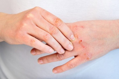 Người mắc bệnh viêm da cơ địa cần tránh lựa chọn các 13Win OKVIP Cá cược bóng đá này