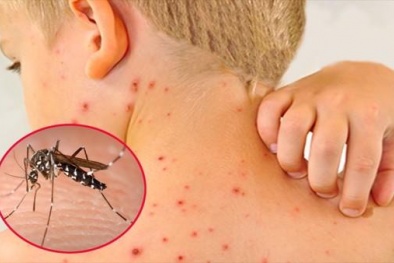 Bộ Y tế yêu cầu nhập dịch truyền đặc trị sốt xuất huyết