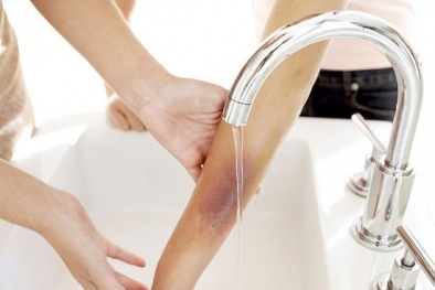Nhiều trẻ bị nhiễm trùng nặng do đắp thuốc lá trị bỏng