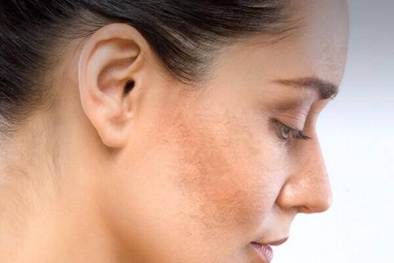 Bác sĩ da liễu cảnh báo: Lột da trị nám không 'thần thánh' như nhiều người nghĩ