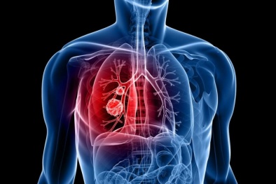 Mỹ phê duyệt thuốc mới điều trị ung thư phổi giai đoạn cuối