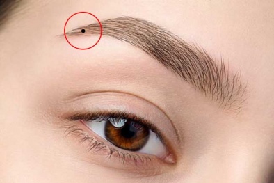 Giữ lại nốt ruồi vì hợp phong thủy dẫn đến ung thư hắc tố da