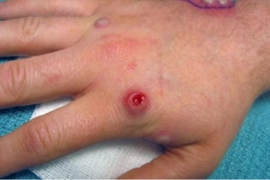 TP.HCM: 18/20 ca mắc đậu mùa khỉ nhiễm HIV
