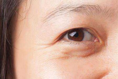 Sử dụng kem dưỡng mắt: Lưu ý thành phần đặc hiệu để đảm bảo an toàn và hiệu quả