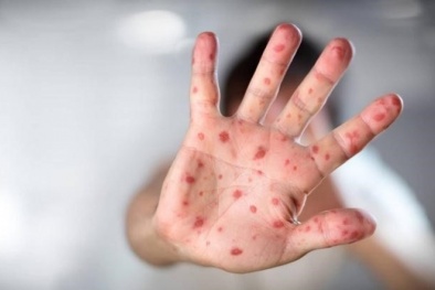 TP.HCM: Cảnh báo bệnh tay – chân – miệng vào mùa