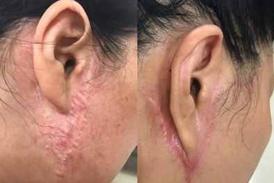 Những hiểm họa khó lường khi phẫu thuật thẩm mỹ căng da mặt