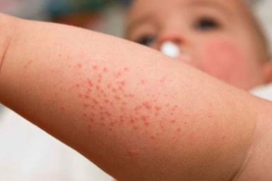 Bộ Y tế cảnh báo gia tăng gấp đôi các ca mắc bệnh sởi