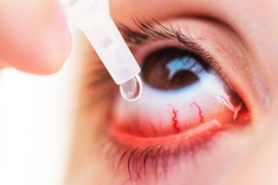 Lạm dụng corticoid nhỏ mắt có thể làm tăng nguy cơ mắc glaucoma gây mù vĩnh viễn