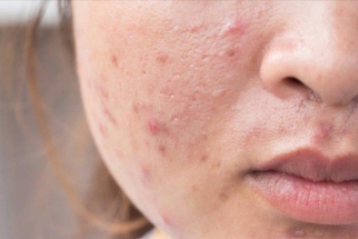 Các sản phẩm chứa benzoyl peroxide, axit salicylic có thể gây dị ứng cho da