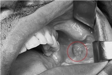 Sau 5 năm phẫu thuật thẩm mỹ tạo má lúm đồng tiền người phụ nữ gặp biến chứng
