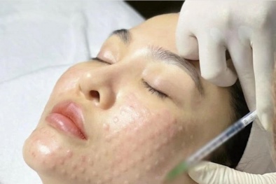 Rủi ro từ tiêm mesotherapy trẻ hoá da cấp tốc