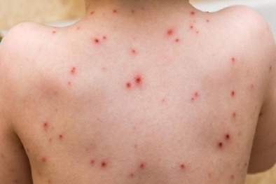 WHO tuyên bố bệnh Mpox là tình trạng y tế công cộng khẩn cấp toàn cầu