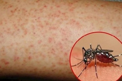 Hà Nội ghi nhận nhiều ca sốt xuất huyết Dengue