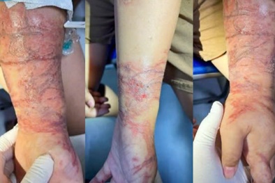 Bác sĩ cảnh báo mùa du lịch: Viêm da tiếp xúc do sứa biển